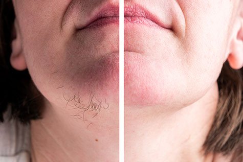 Long-lasting results with permanent hair reduction